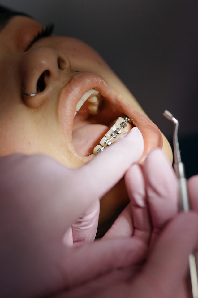 Co się dzieje z zębami po zdjęciu aparatu ortodontycznego?