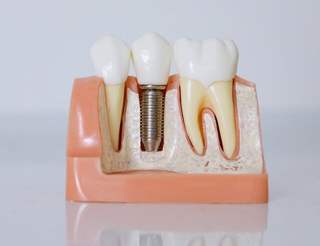 definicja implantów zębowych