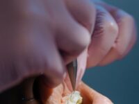 Jakie są objawy, że zęby zaczynają się przesuwać po zdjęciu aparatu?