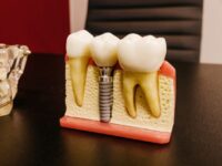 Kiedy ból po wszczepieniu implantu zęba powinien skłonić do kontaktu z dentystą?