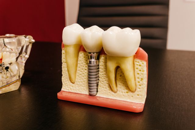 Kiedy ból po wszczepieniu implantu zęba powinien skłonić do kontaktu z dentystą?